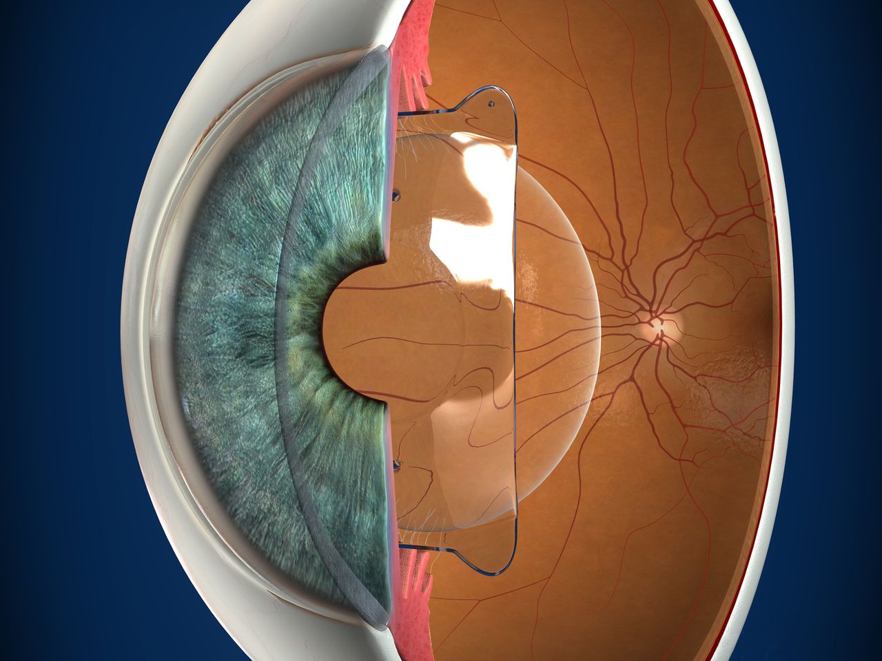 Implantable collamer lens - DVITA